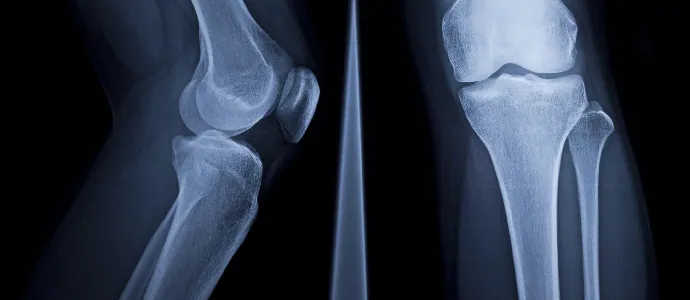 Knee X-ray, lateral and frontal views